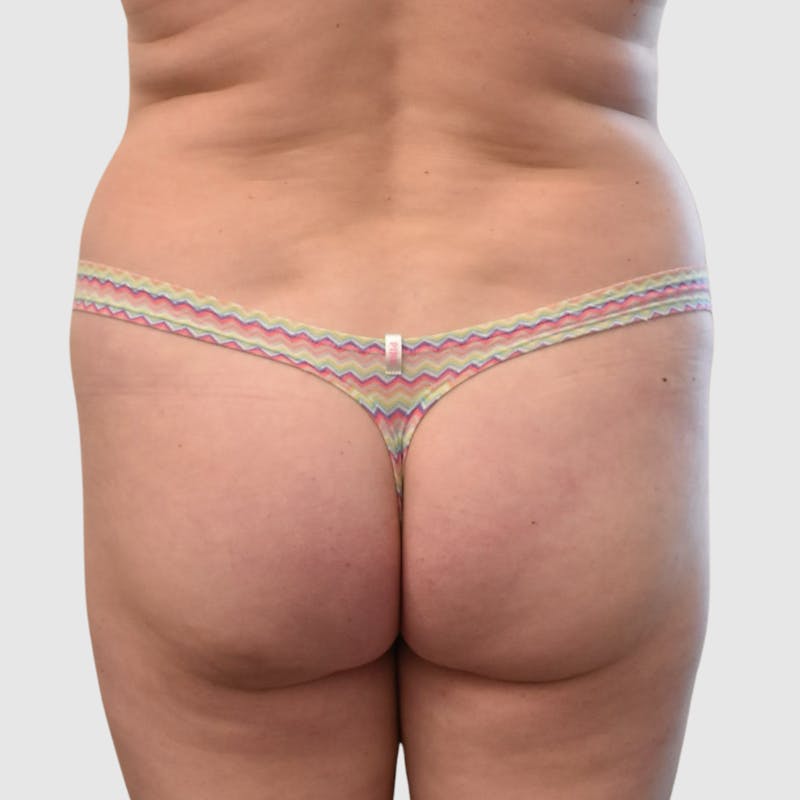 Brazilian Butt Lift Before & After Gallery - Patient 295941 - Image 1
