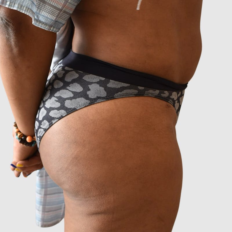 Brazilian Butt Lift Before & After Gallery - Patient 398105 - Image 4