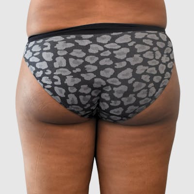 Brazilian Butt Lift Before & After Gallery - Patient 398105 - Image 1
