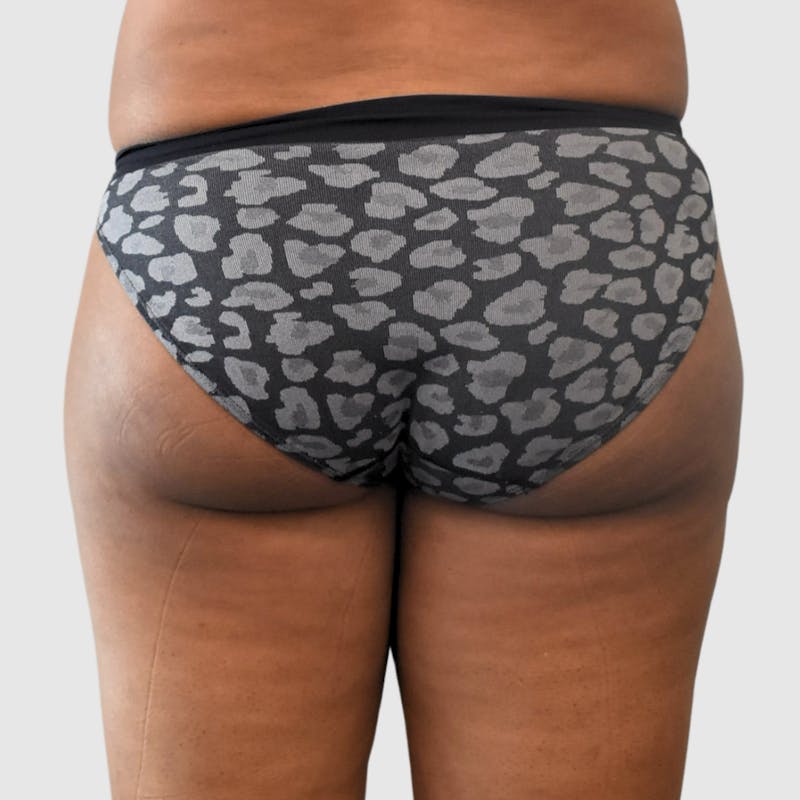 Brazilian Butt Lift Before & After Gallery - Patient 398105 - Image 1