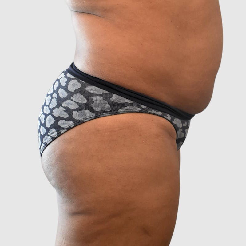 Brazilian Butt Lift Before & After Gallery - Patient 398105 - Image 3