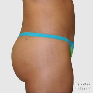 Brazilian Butt Lift Before & After Gallery - Patient 328787 - Image 2