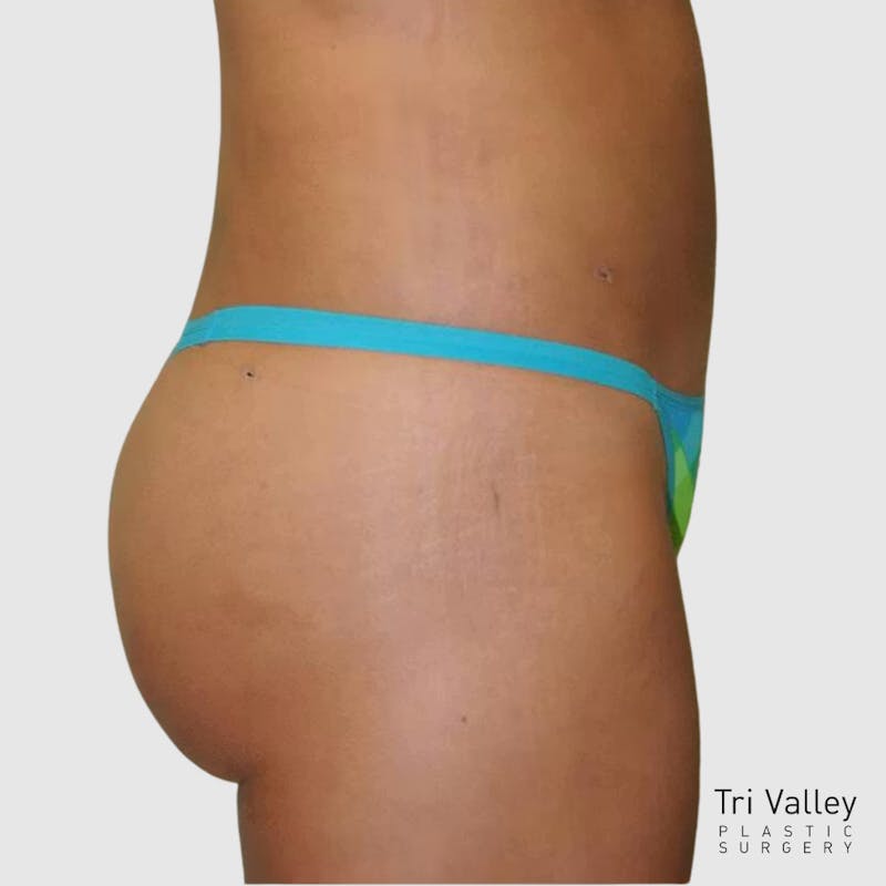 Brazilian Butt Lift Before & After Gallery - Patient 328787 - Image 2