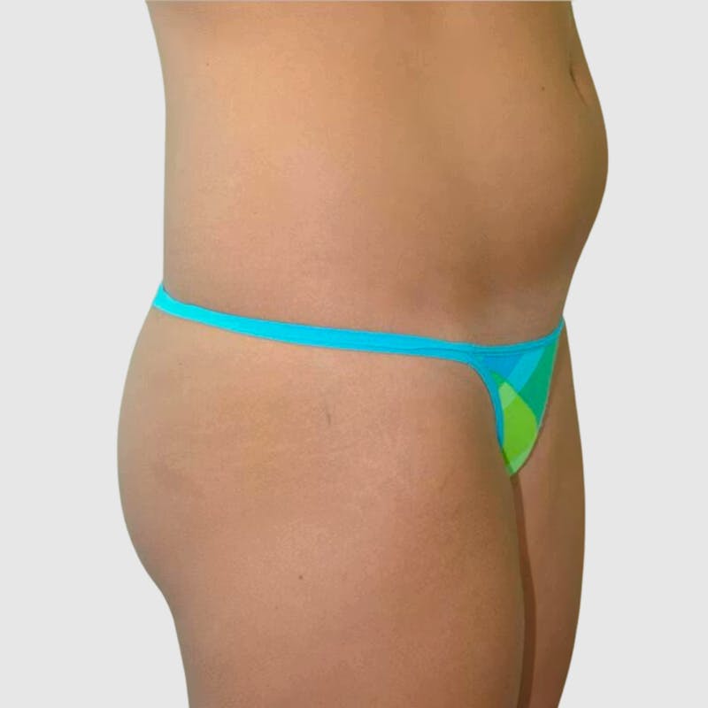 Brazilian Butt Lift Before & After Gallery - Patient 328787 - Image 1