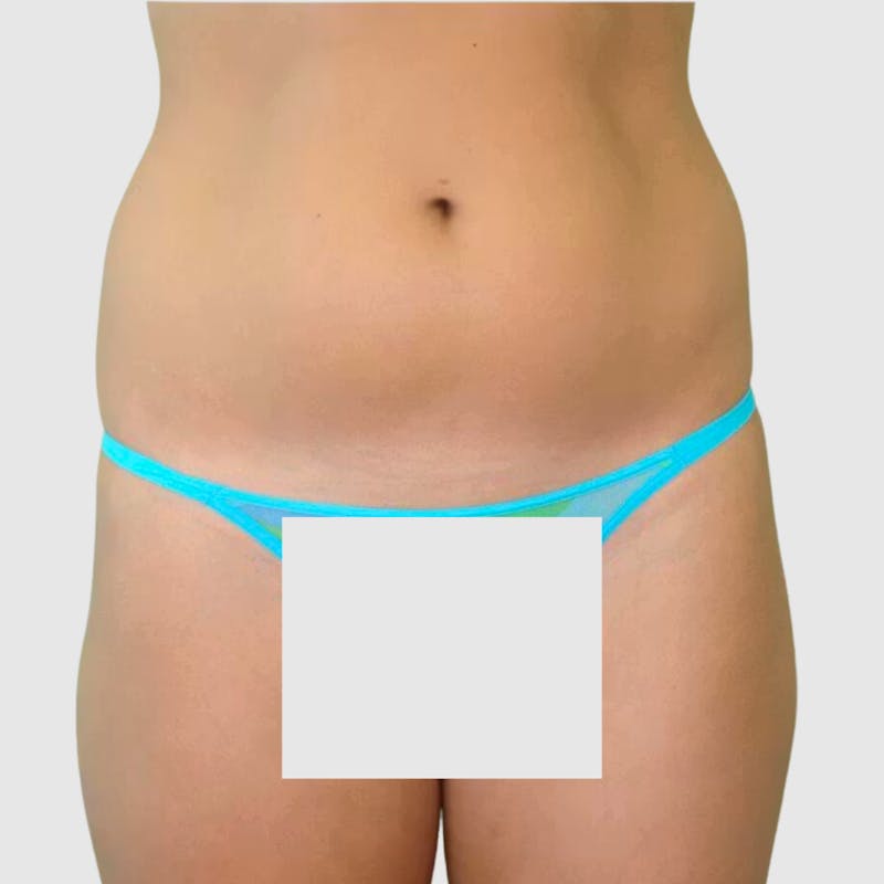 Brazilian Butt Lift Before & After Gallery - Patient 328787 - Image 3