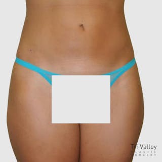 Brazilian Butt Lift Before & After Gallery - Patient 328787 - Image 4
