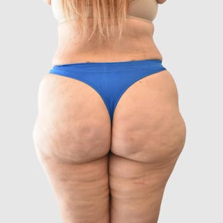 Brazilian Butt Lift Before & After Gallery - Patient 935722 - Image 6