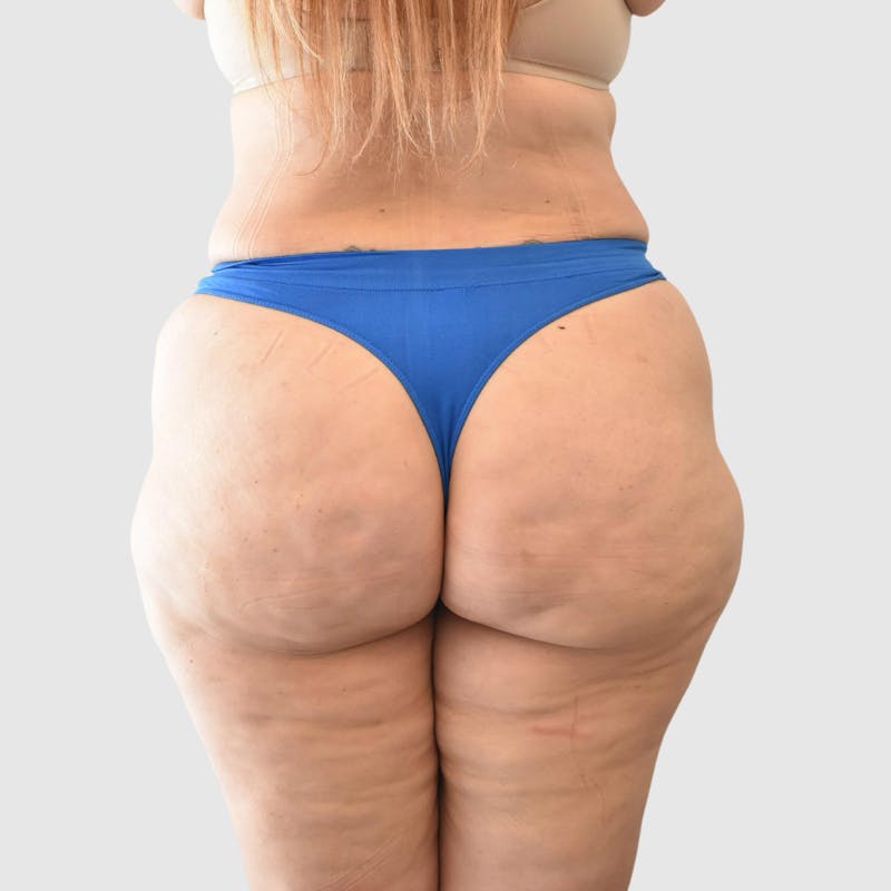 Brazilian Butt Lift Before & After Gallery - Patient 935722 - Image 6