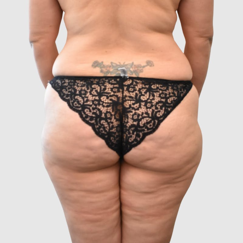 Brazilian Butt Lift Before & After Gallery - Patient 935722 - Image 5
