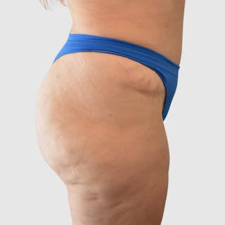 Brazilian Butt Lift Before & After Gallery - Patient 935722 - Image 2