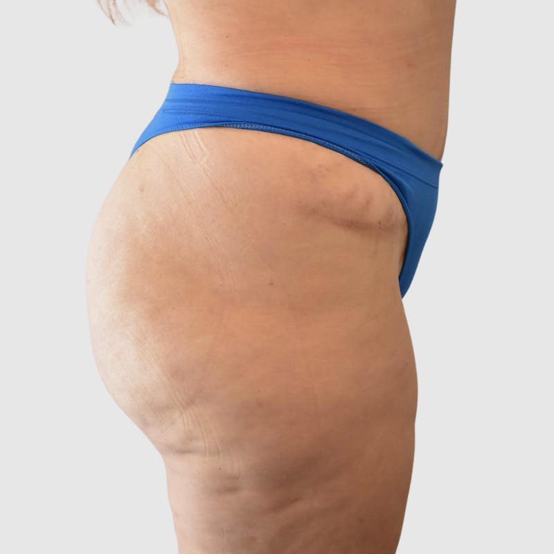 Brazilian Butt Lift Before & After Gallery - Patient 935722 - Image 2