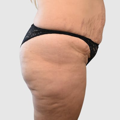 Brazilian Butt Lift Before & After Gallery - Patient 935722 - Image 1