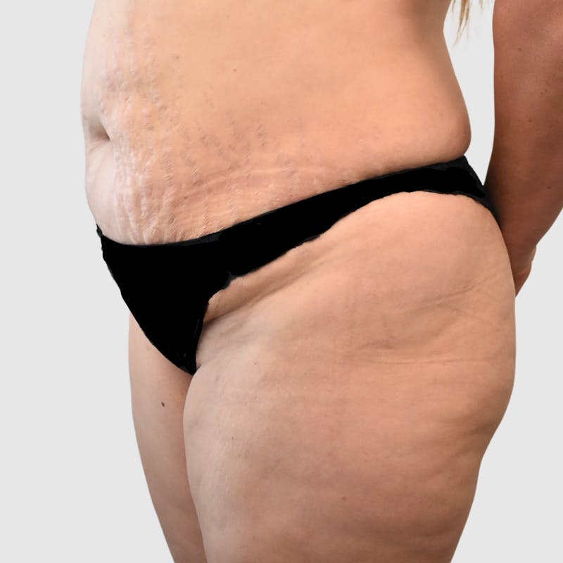 Brazilian Butt Lift Before & After Gallery - Patient 935722 - Image 3