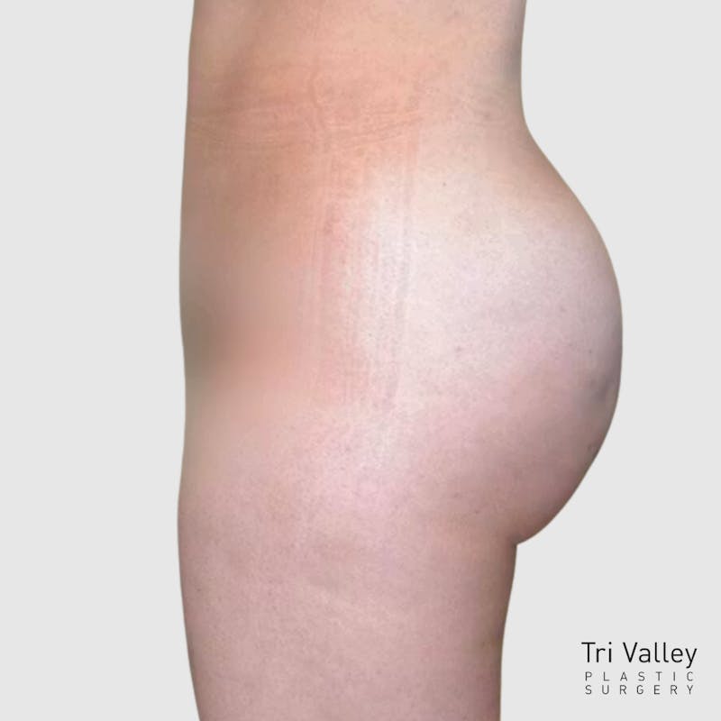 Brazilian Butt Lift Before & After Gallery - Patient 335609 - Image 2