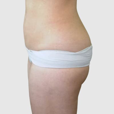Brazilian Butt Lift Before & After Gallery - Patient 335609 - Image 1