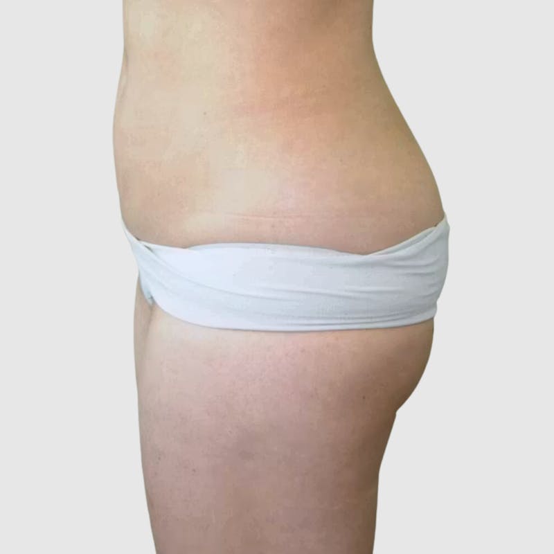 Brazilian Butt Lift Before & After Gallery - Patient 335609 - Image 1