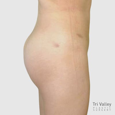Brazilian Butt Lift Before & After Gallery - Patient 244176 - Image 2