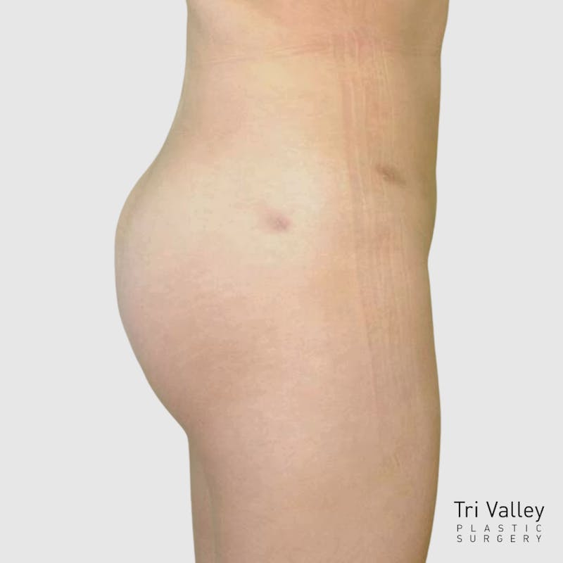 Brazilian Butt Lift Before & After Gallery - Patient 244176 - Image 2
