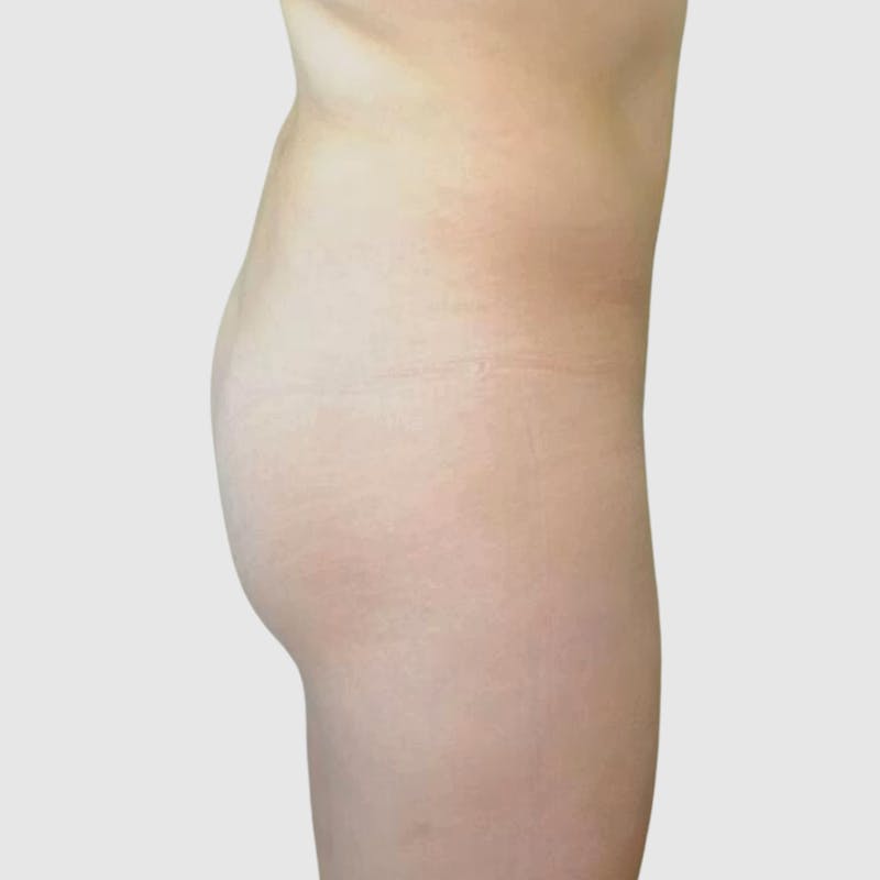 Brazilian Butt Lift Before & After Gallery - Patient 244176 - Image 1