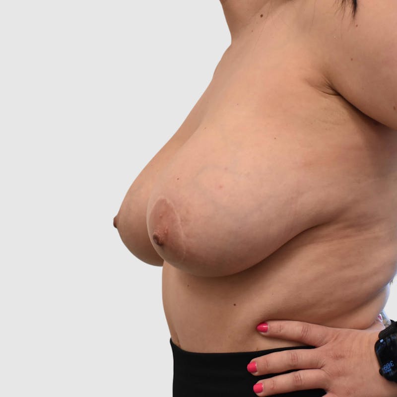 Breast Implant Removal Before & After Gallery - Patient 580291 - Image 3