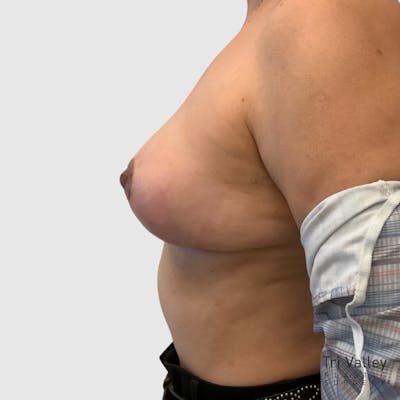 Breast Implant Removal Before & After Gallery - Patient 348702 - Image 2