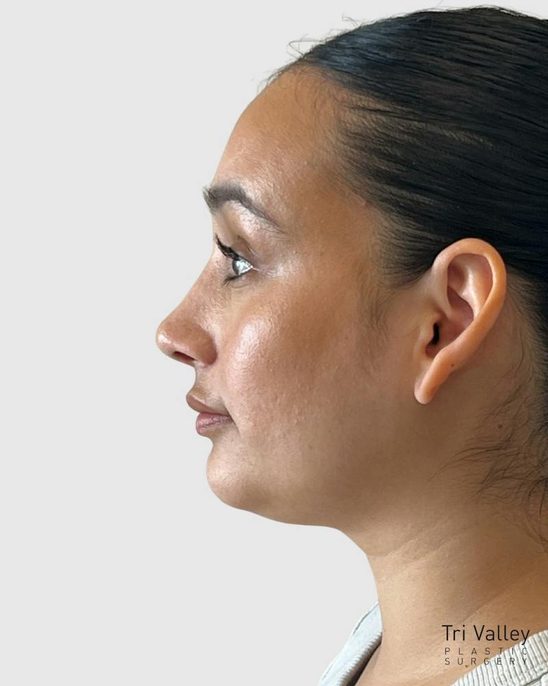 Rhinoplasty Before & After Gallery - Patient 167595 - Image 2
