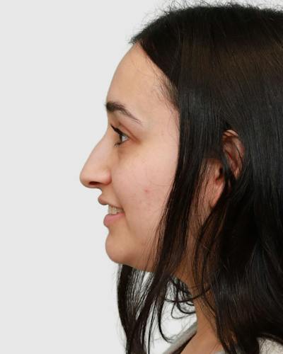 Rhinoplasty Before & After Gallery - Patient 167595 - Image 1