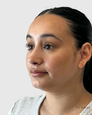 Rhinoplasty Before & After Gallery - Patient 167595 - Image 4