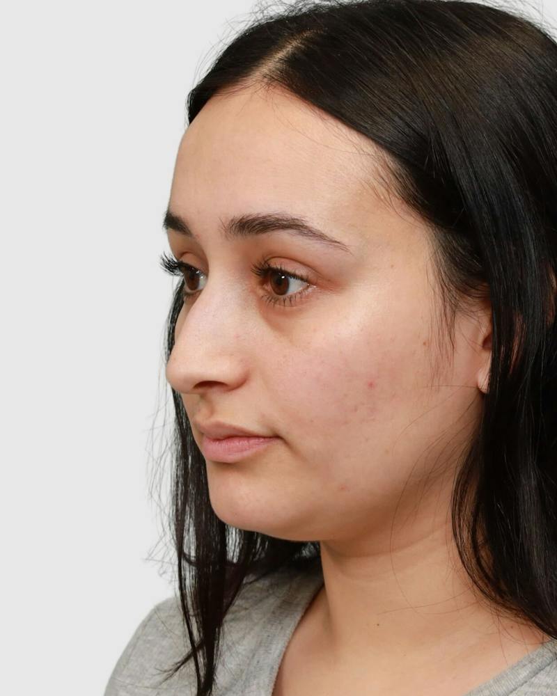 Rhinoplasty Before & After Gallery - Patient 167595 - Image 3