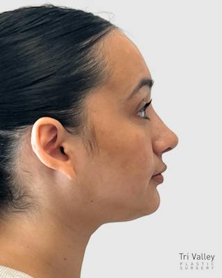 Rhinoplasty Before & After Gallery - Patient 167595 - Image 8