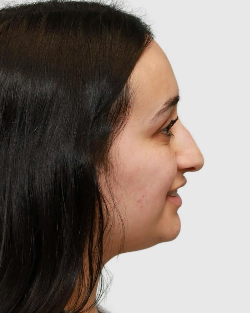 Rhinoplasty Before & After Gallery - Patient 167595 - Image 7