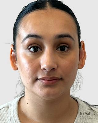 Rhinoplasty Before & After Gallery - Patient 167595 - Image 6
