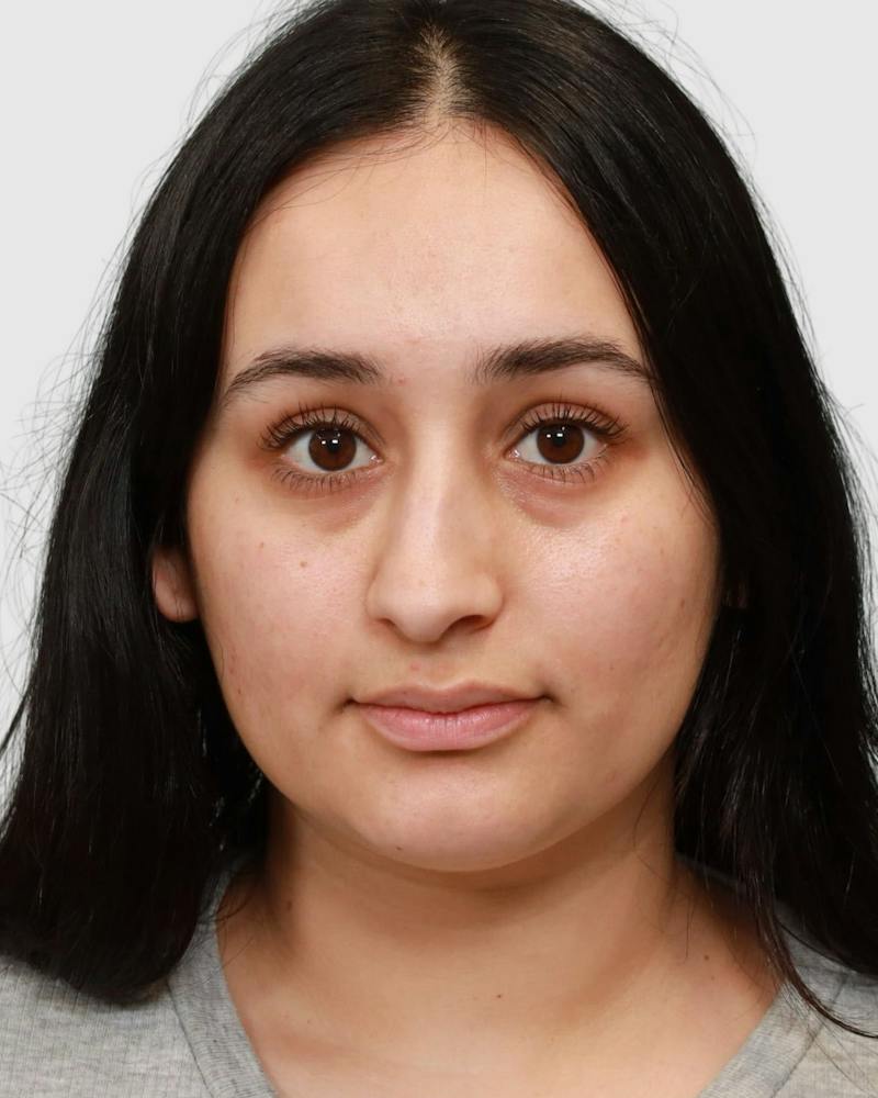 Rhinoplasty Before & After Gallery - Patient 167595 - Image 5