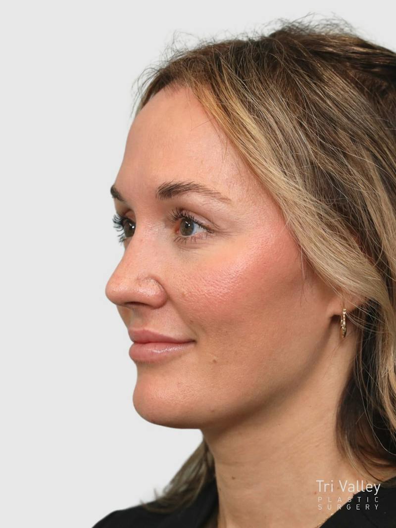 Rhinoplasty Before & After Gallery - Patient 243928 - Image 4