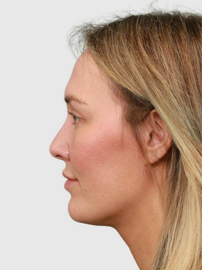 Rhinoplasty Before & After Gallery - Patient 243928 - Image 1