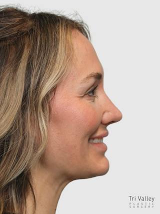 Rhinoplasty Before & After Gallery - Patient 243928 - Image 10