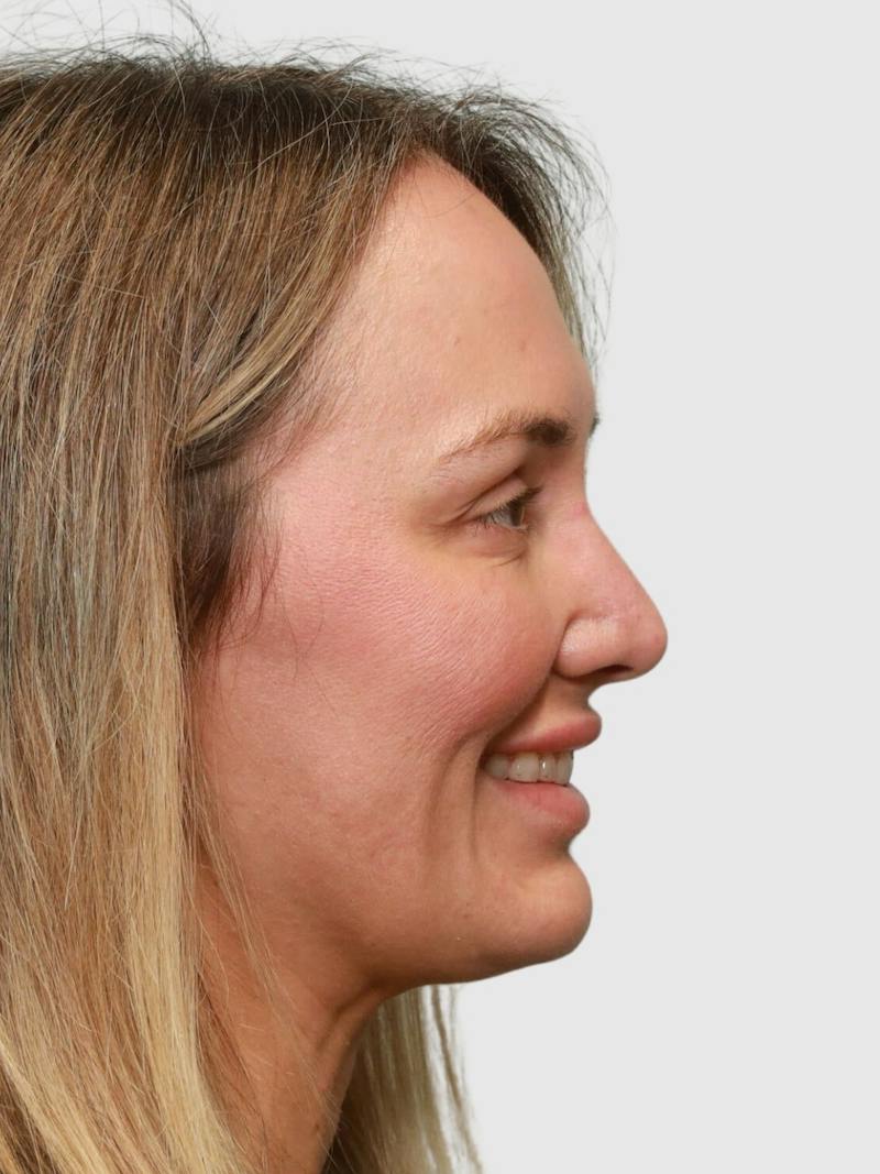 Rhinoplasty Before & After Gallery - Patient 243928 - Image 9