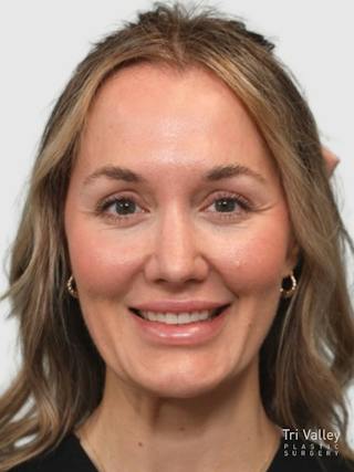 Rhinoplasty Before & After Gallery - Patient 243928 - Image 8