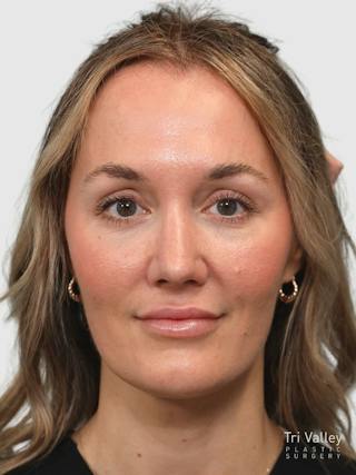 Rhinoplasty Before & After Gallery - Patient 243928 - Image 6