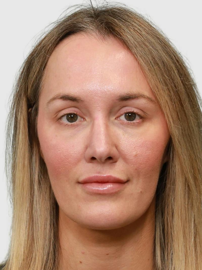 Rhinoplasty Before & After Gallery - Patient 243928 - Image 5