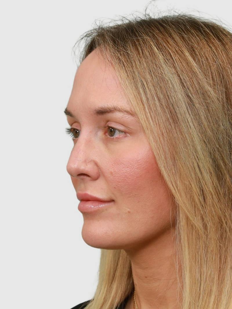 Rhinoplasty Before & After Gallery - Patient 243928 - Image 3