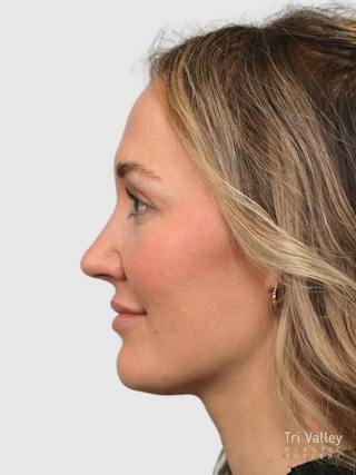 Rhinoplasty Before & After Gallery - Patient 243928 - Image 2