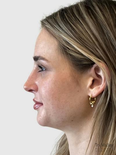 Rhinoplasty Before & After Gallery - Patient 147302 - Image 2