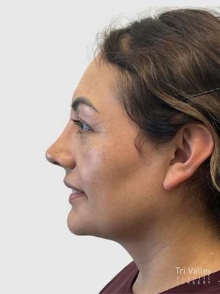 Rhinoplasty Before & After Gallery - Patient 278610 - Image 2