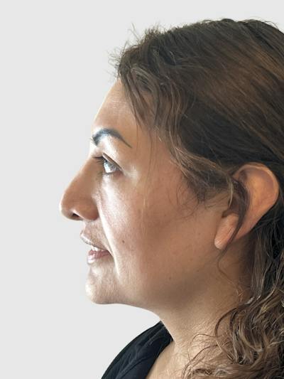 Rhinoplasty Before & After Gallery - Patient 278610 - Image 1
