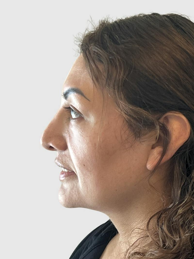 Rhinoplasty Before & After Gallery - Patient 278610 - Image 1