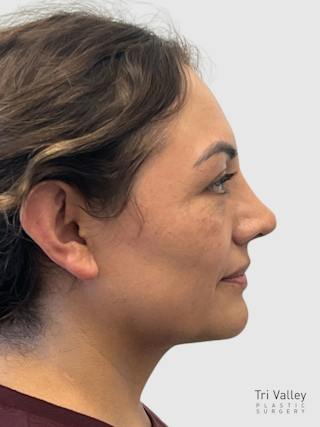 Rhinoplasty Before & After Gallery - Patient 278610 - Image 4