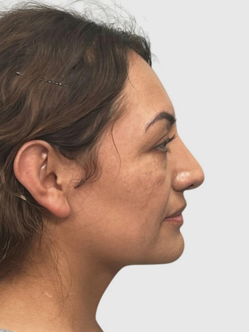 Rhinoplasty Before & After Gallery - Patient 278610 - Image 3