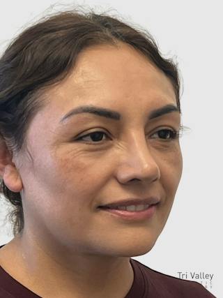 Rhinoplasty Before & After Gallery - Patient 278610 - Image 6