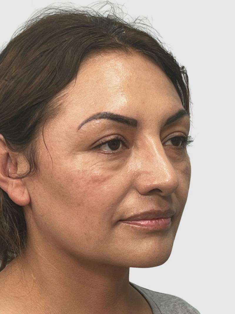 Rhinoplasty Before & After Gallery - Patient 278610 - Image 5